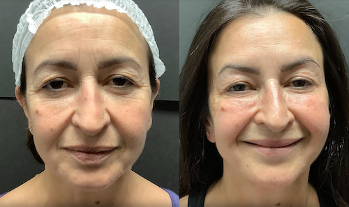 rf laser wrinkle reduction before after mississauga oakville